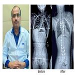 KIMS Doctors Achieve Breakthrough Saves Young Girl Life with Complex Spine Surgery