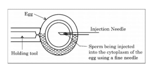 Illustration of sperm being injected into the cytoplasm of the egg using a fine needle.